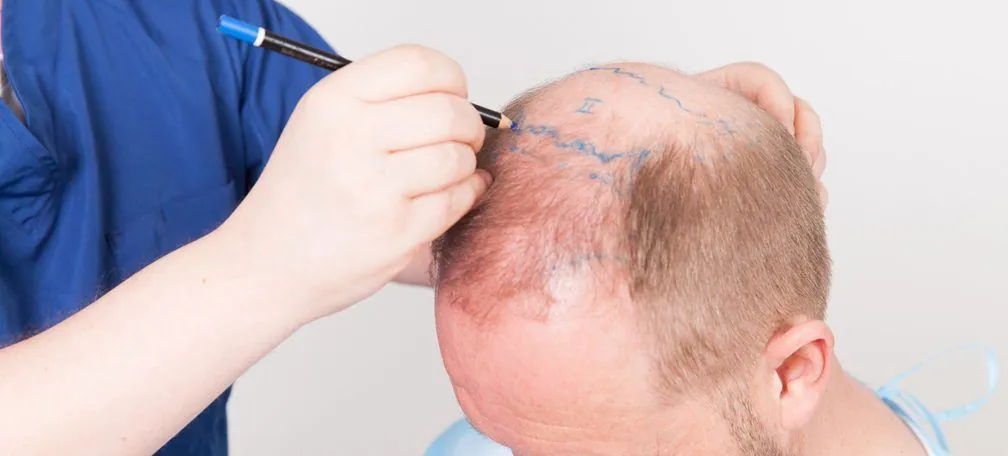 Tracé de la ligne frontale avant une greffe de cheveux, Clinique Churchill Bruxelles